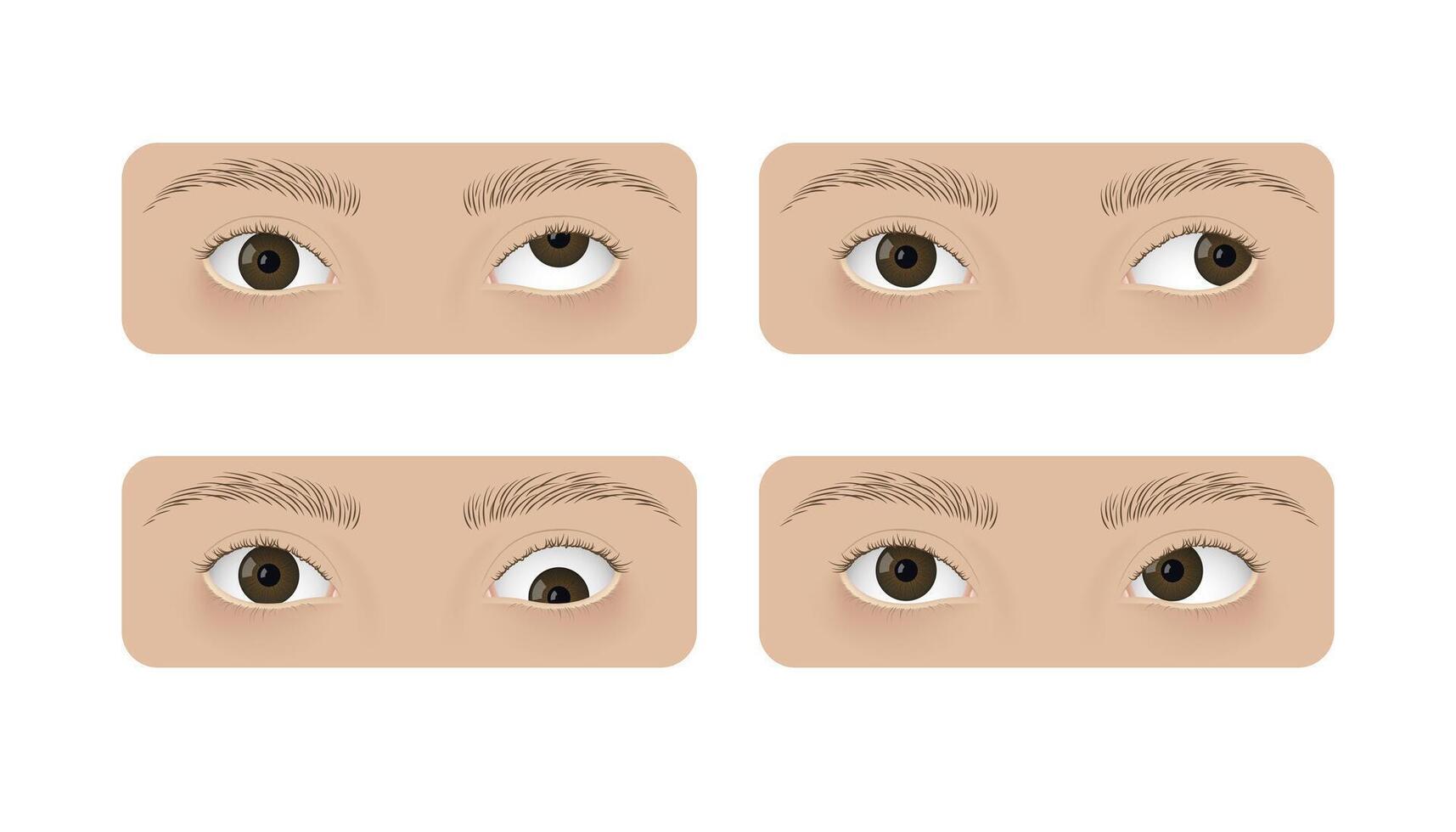 Realistic human eyes with strabismus. Crossed eyes, hypertropia, exotropia, hypotropia and esotropia vector
