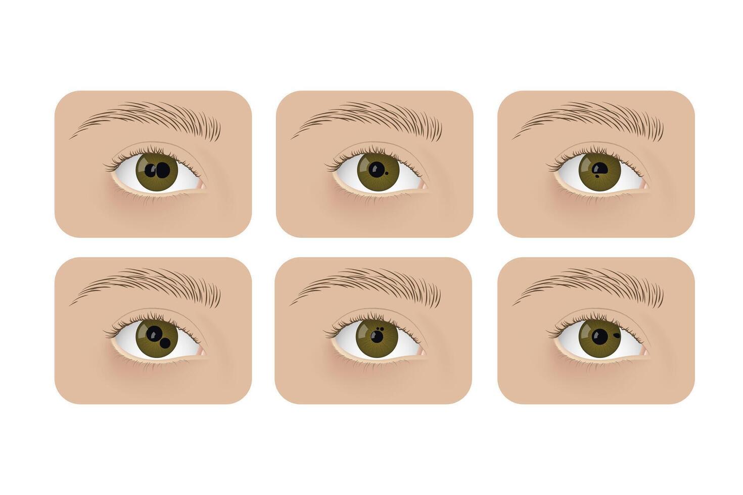 Realistic human eyes with polycoria. Human sickness, anatomy, health. vector