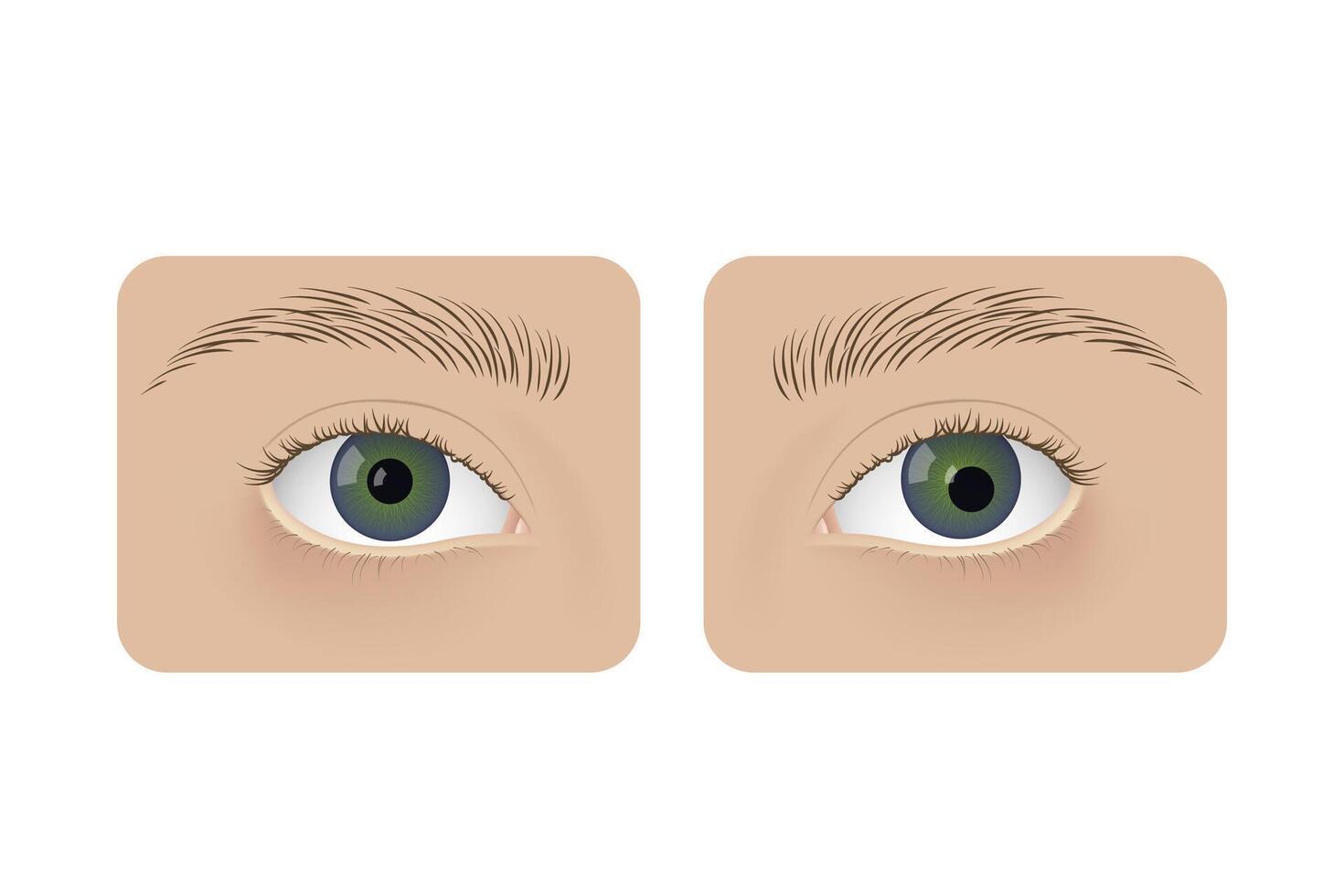 Realistic human normal eyes and with corectopia. Human sick, anatomy, health. vector