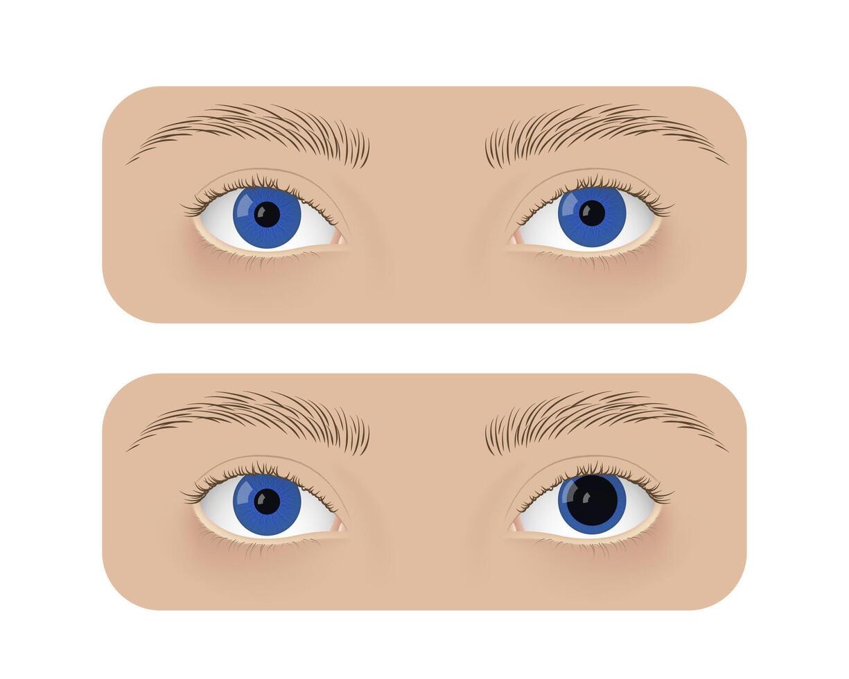 Realistic human normal eyes and with anisocoria. Unequal pupil, anatomy, health. vector