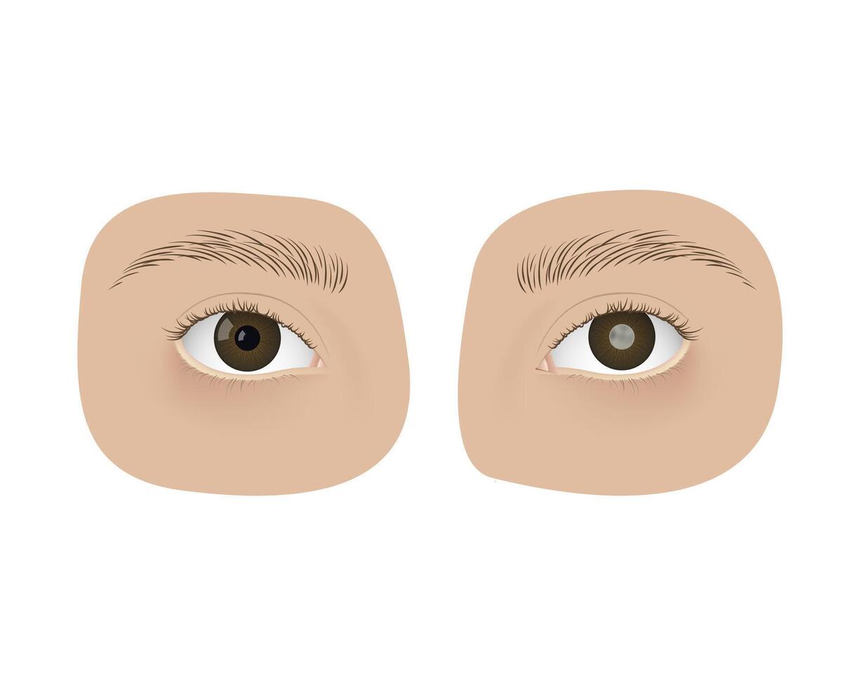 Realistic human healthy eye and with cataract. Disease, anatomy, health. vector