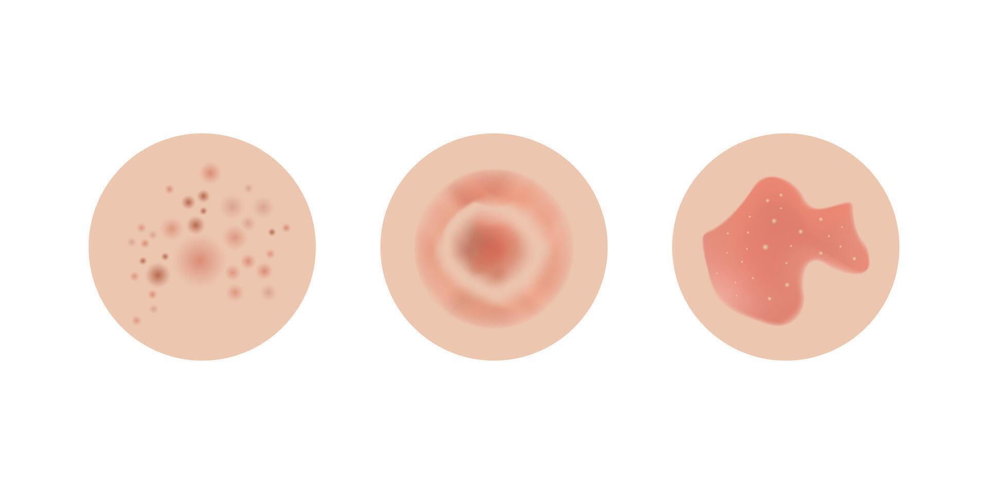 Neurodermatitis examples, allergic problems. Red rash and spots, itchy, swollen redness skin. vector