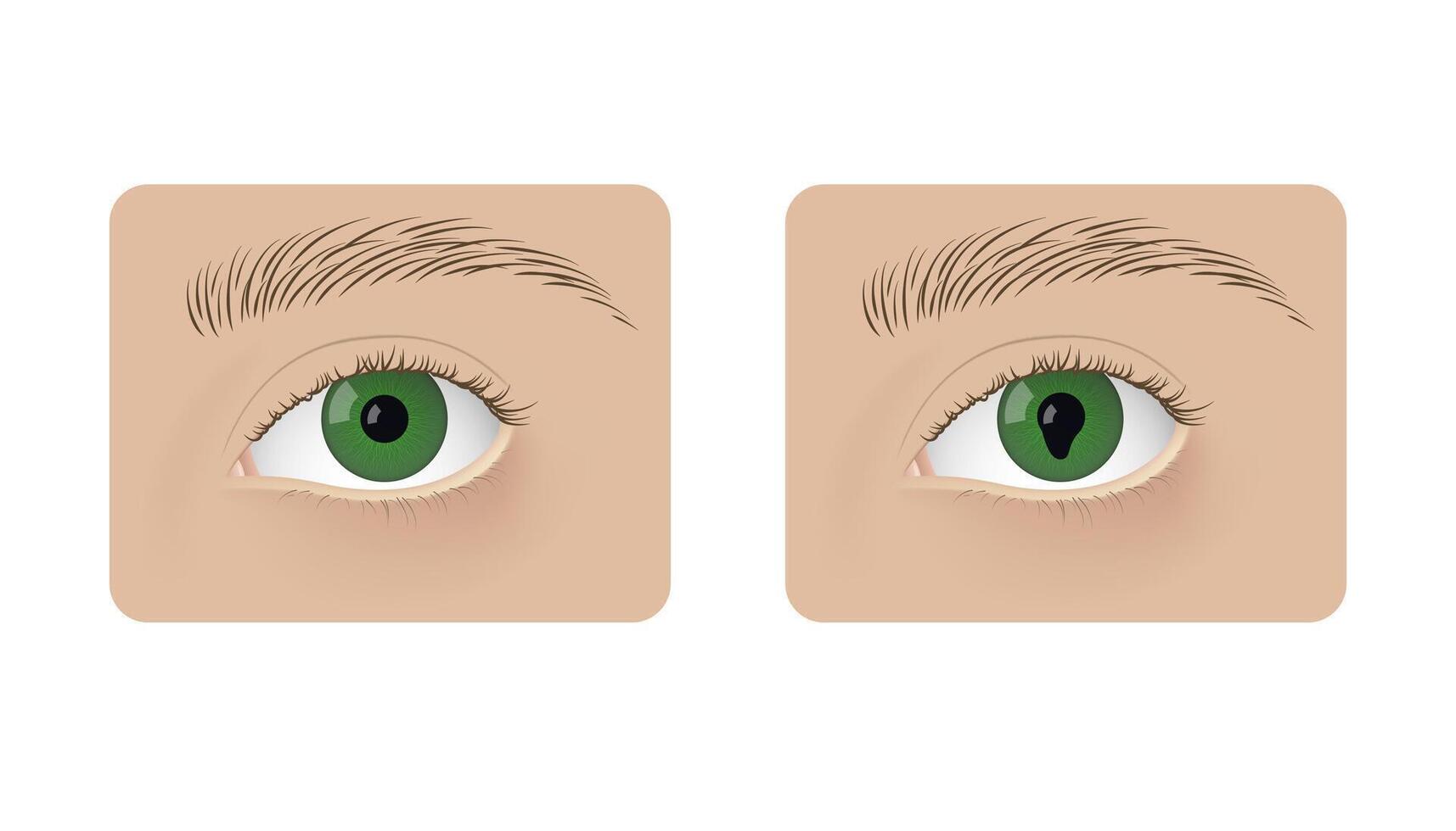 Realistic human normal eyes and with colomba. Human malady, anatomy, health. vector