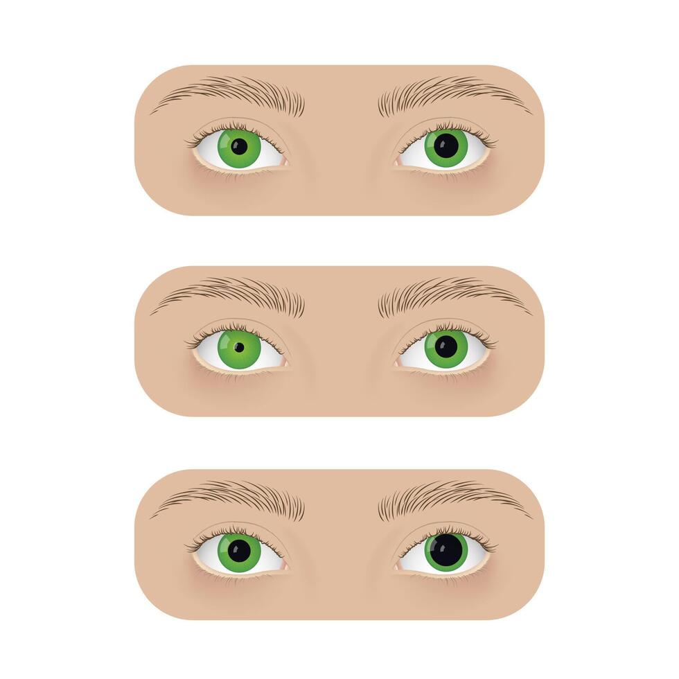 Realistic human eyes with anisocoria. Unequal pupil, anatomy, health. vector