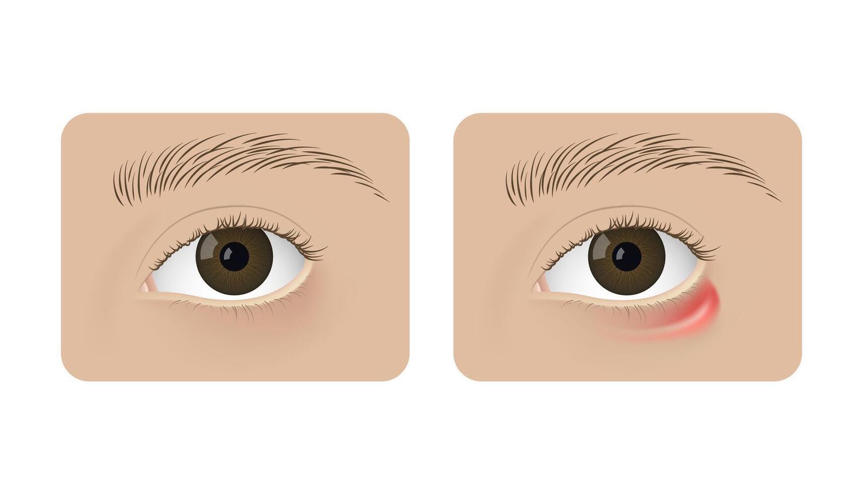 Realistic human healthy eye and with stye. Red inflammation, anatomy, health. vector
