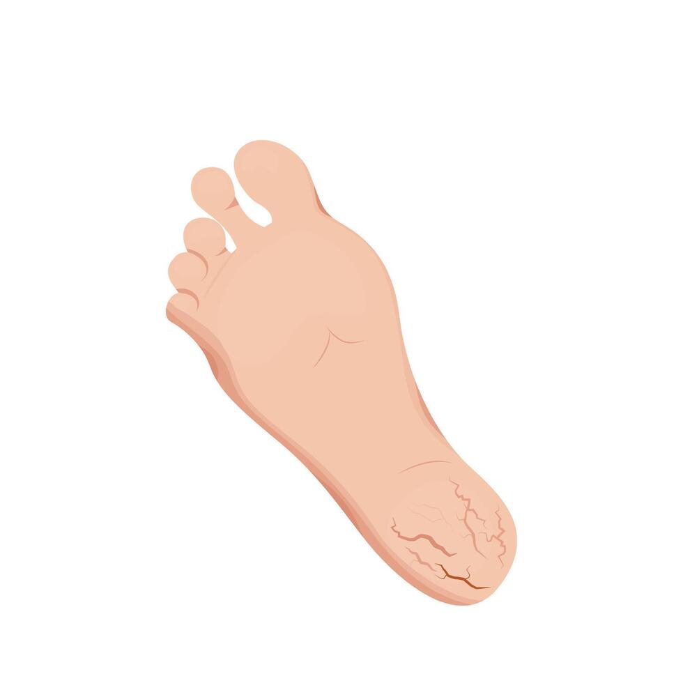 Cracks on feet design. Dry and rough skin on heel, slough and calluses. vector