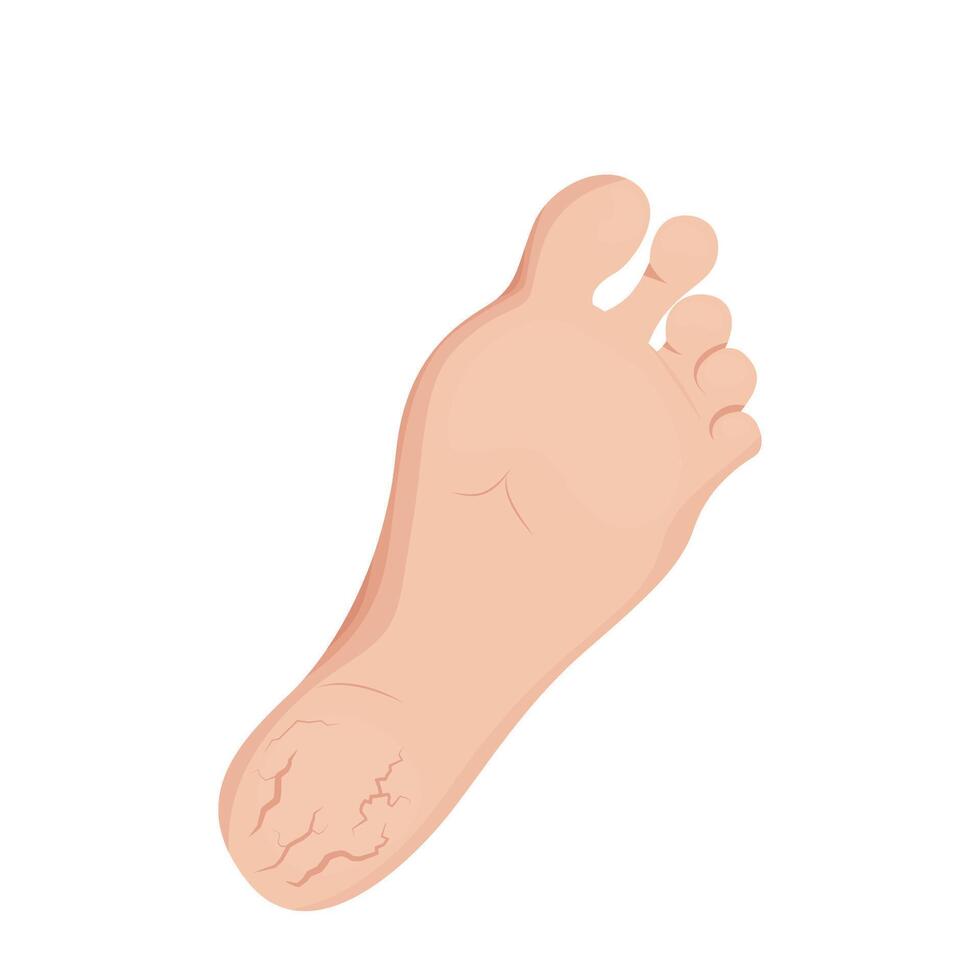 Cracks on feet design. Dry skin on heel, slough and calluses. vector