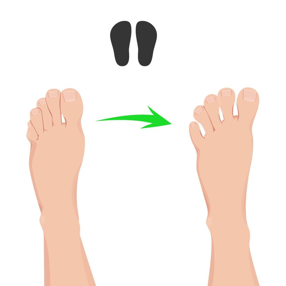 Compare feet before and after barefoot shoes. Orthopedic and anatomical shoes for adult and children. vector