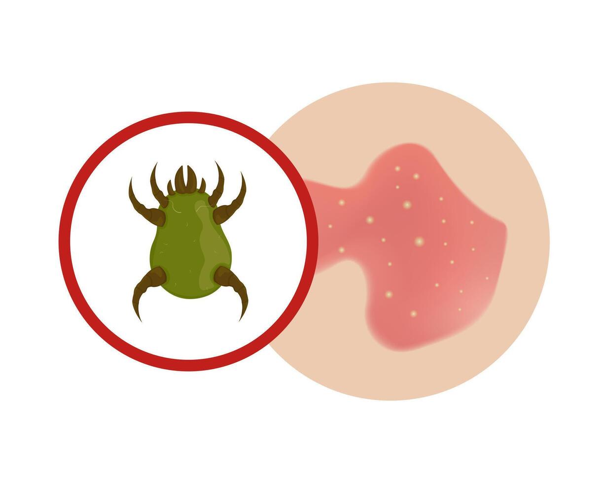 Skin allergy to dust mites. Green microscopic bug causes dermatitis. vector