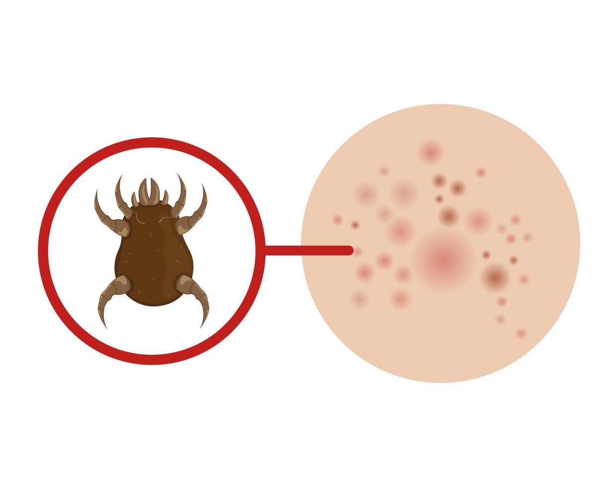 Skin allergy to dust mites. Brown microscopic bug causes neurodermatitis. vector