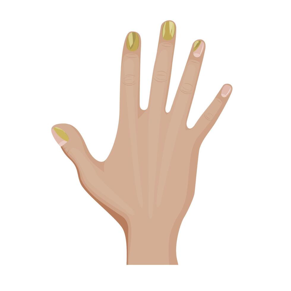 Onychomycosis on the fingernail. Fungal infection of nail on hand. vector