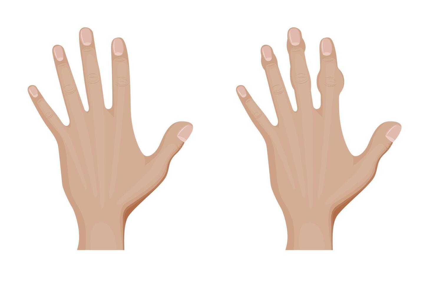 Healthy Hand and Hand with Osteoarthritis. Person with Sick Palm, feeling pain and discomfort. vector