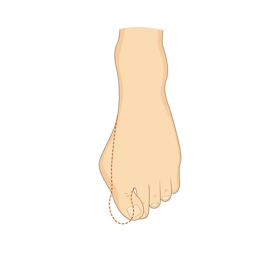 Hallux valgus surgery correction. Medical orthopedics vector
