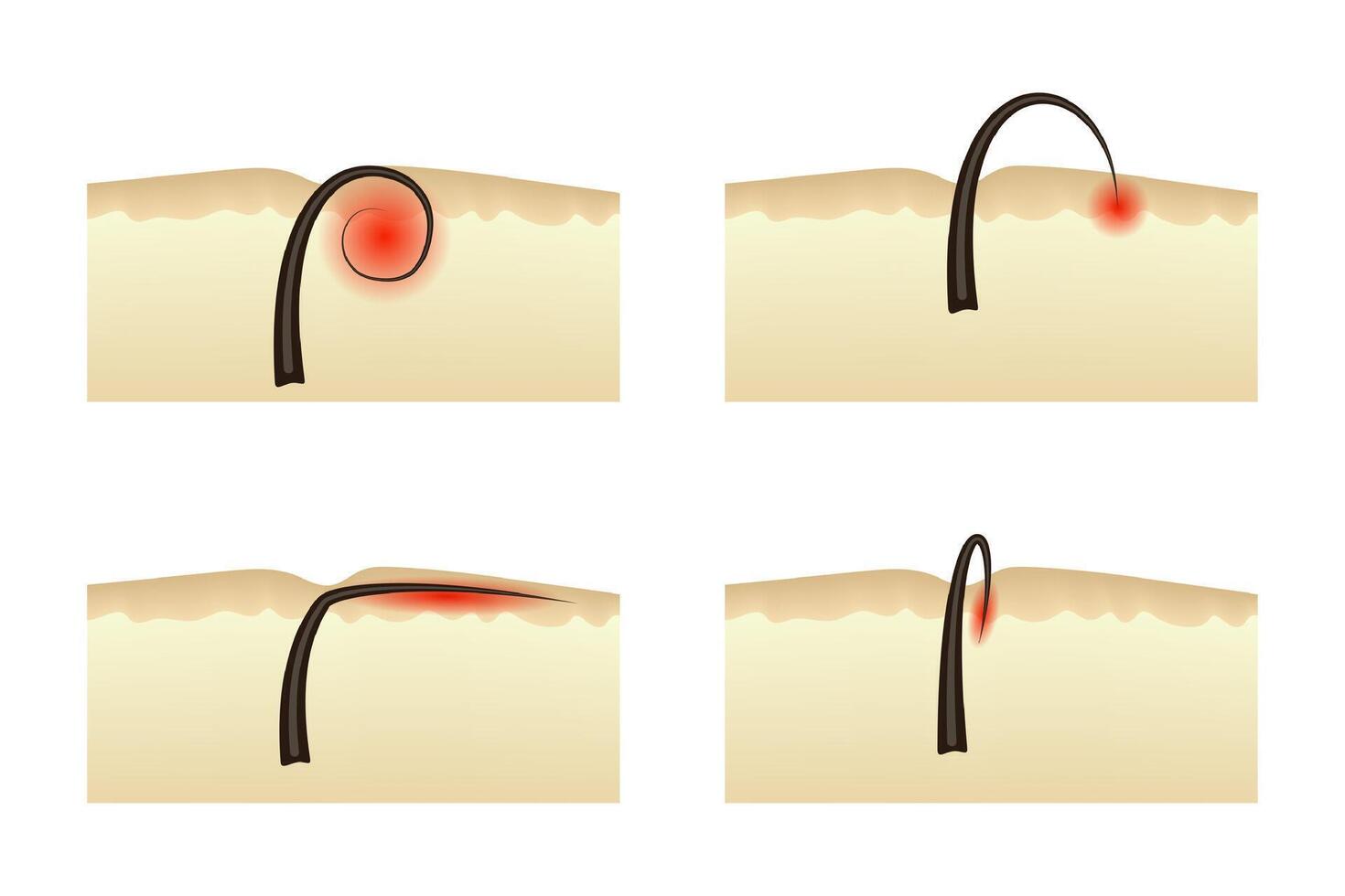 Ingrown hairs after epilation. Inflammation of the skin dermatology. vector