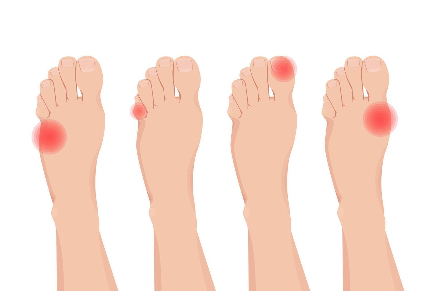 Foot pain and numb. Arthritis and neuropathy disease, joint illness. vector