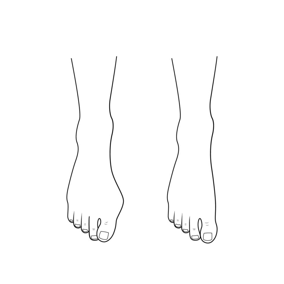Hallux valgus, bunion surgery correction. vector