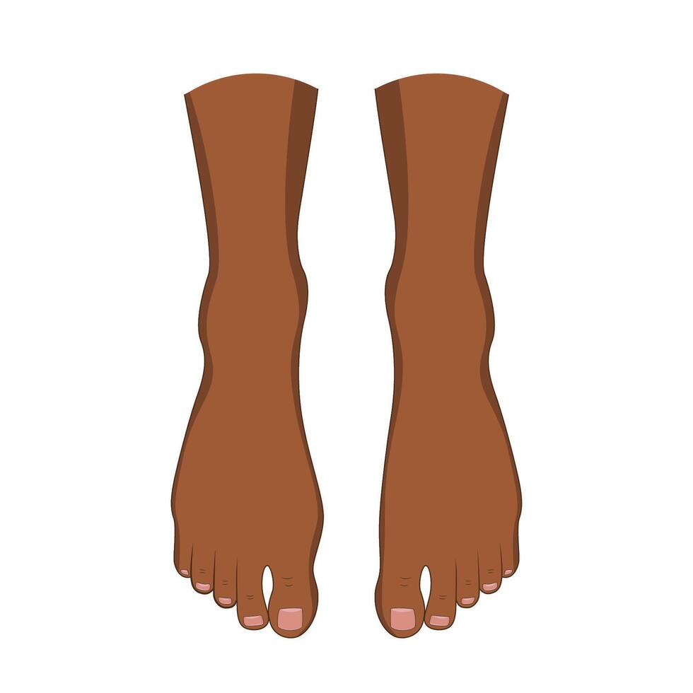 Hallux valgus problem. Orthopedics bunion health vector