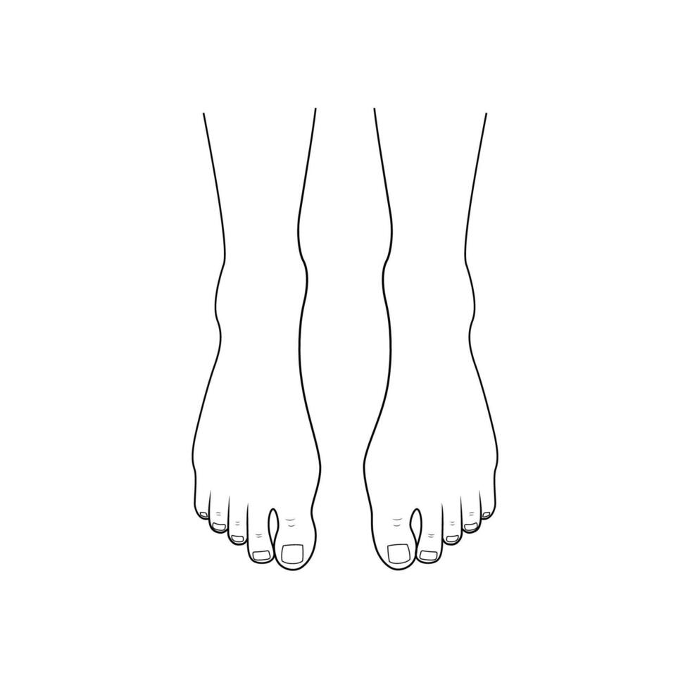 Hallux valgus, mild bunion. Orthopedics foot illness vector
