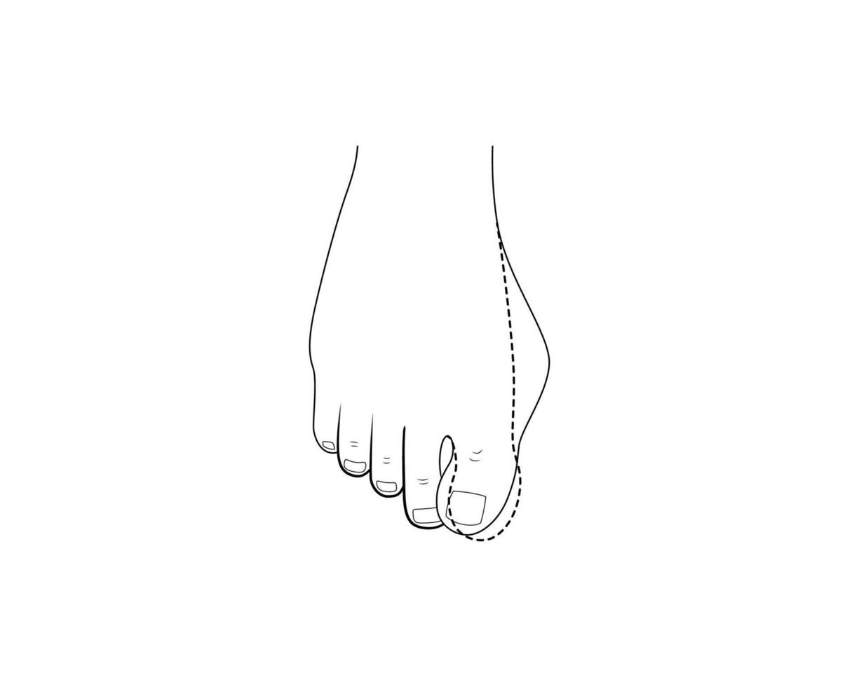 Hallux valgus surgery correction. Orthopedics bunion health vector