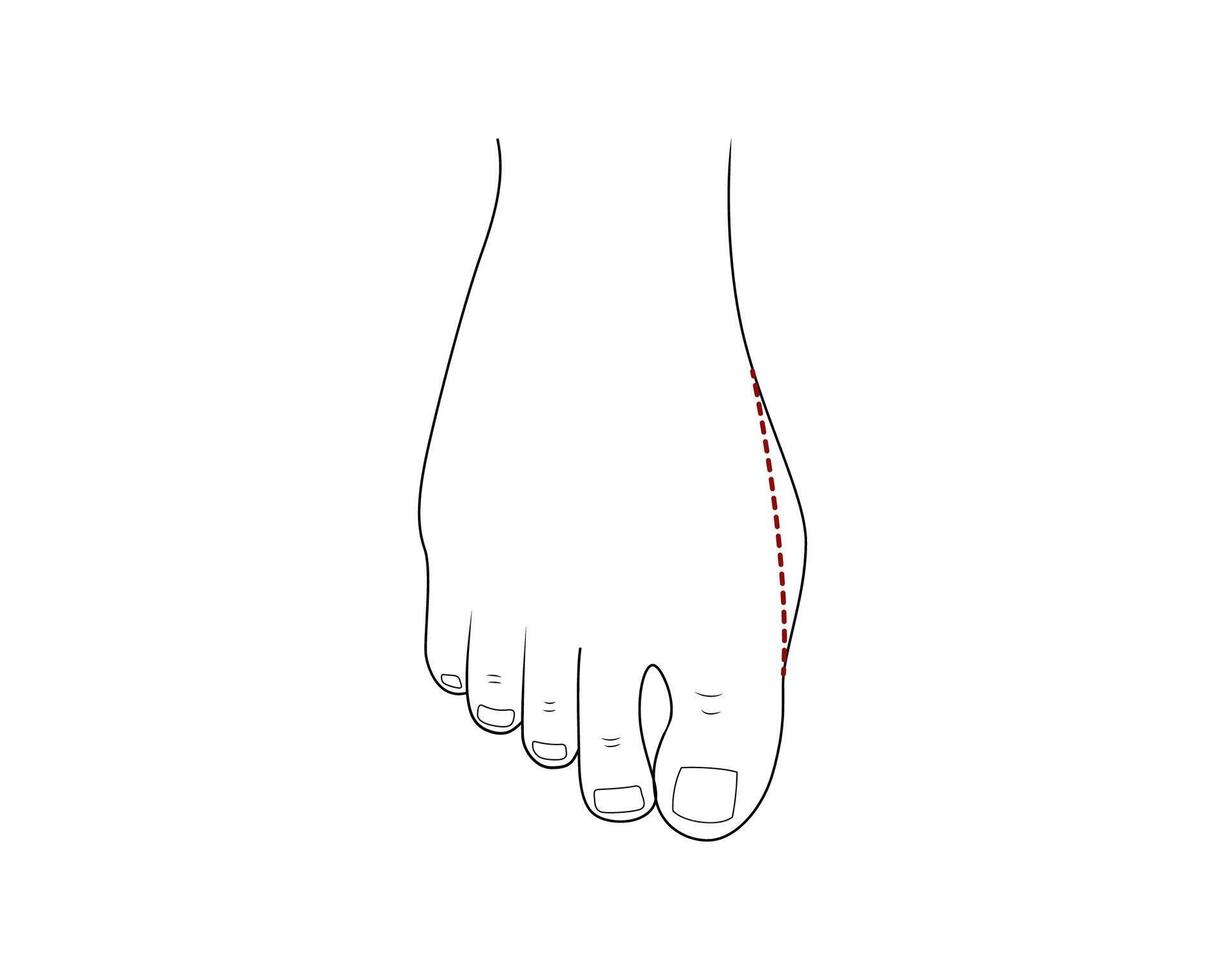 Bunion foot problem. Orthopedics bunion health vector