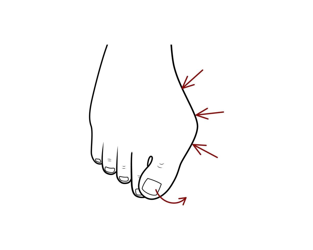 Hallux valgus surgery correction. Orthopedics health vector