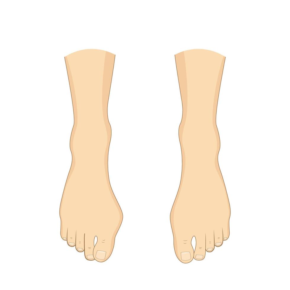 Bunion problem. Orthopedics bunion health vector