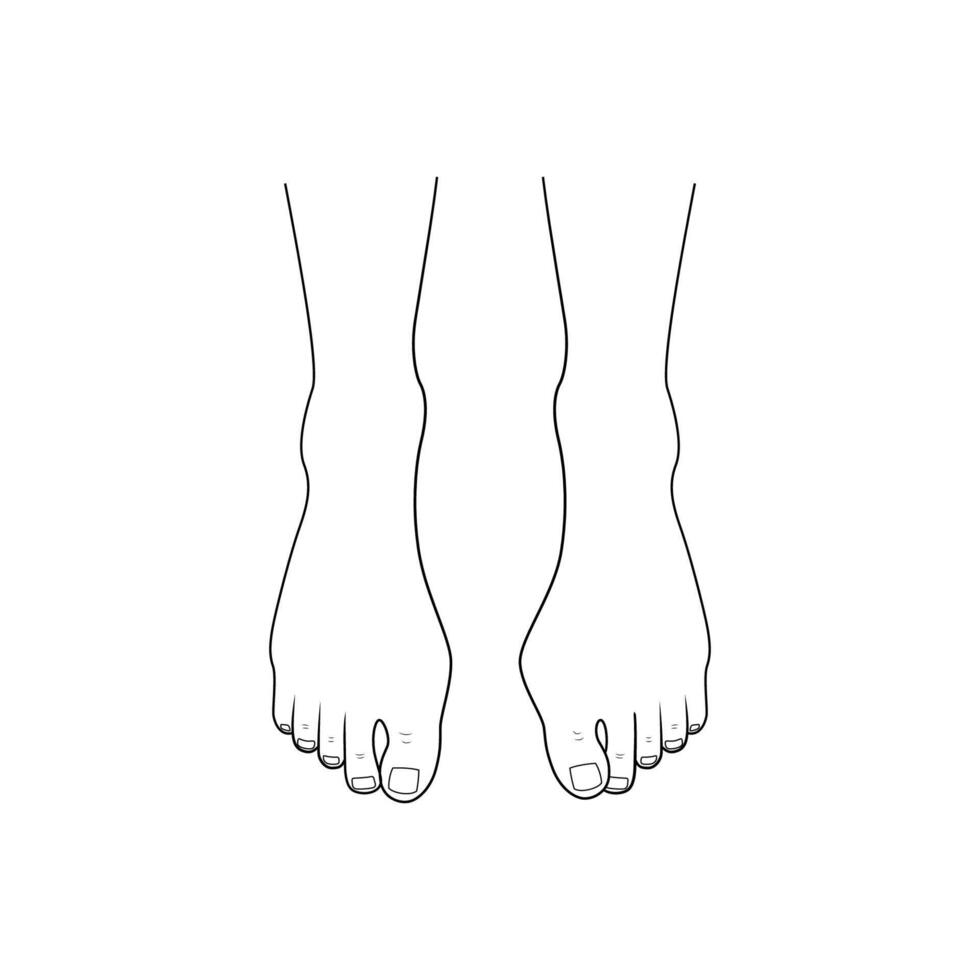 Hallux valgus, bunion. Orthopedics foot illness vector