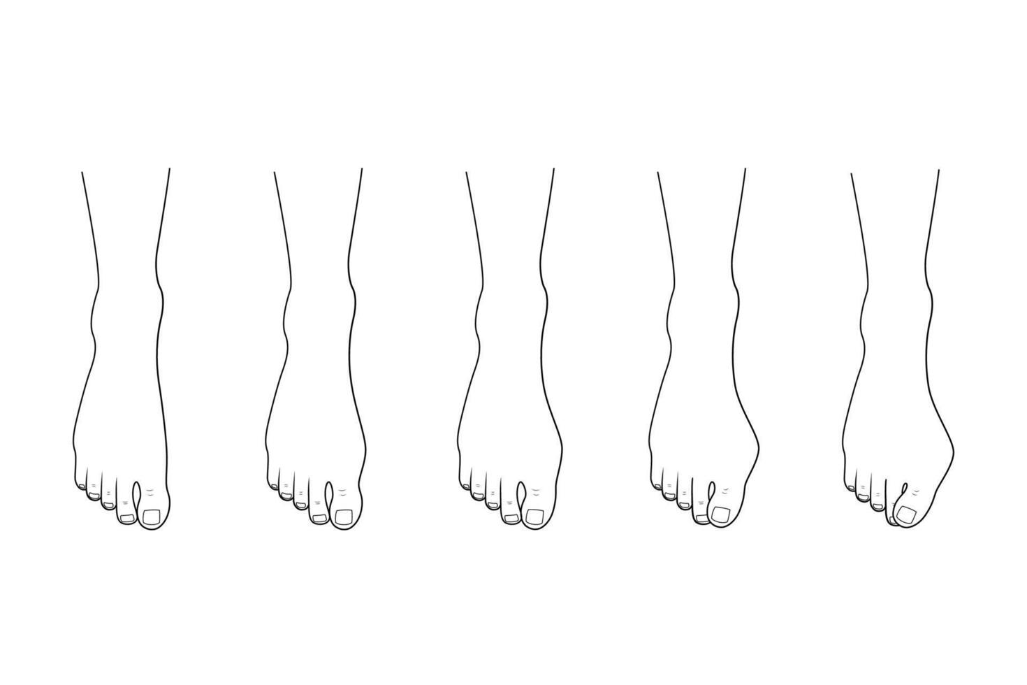 Hallux valgus disease stage. Orthopedics foot illness vector