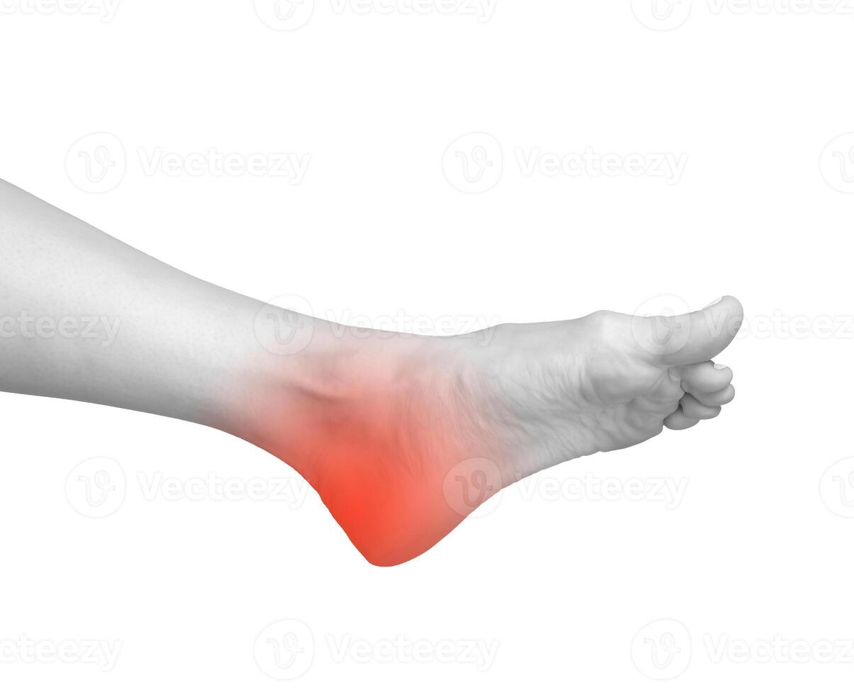 Foot pain, heel ache, joint problem, and neuropathy symptoms. Red, swollen feet with muscle strain photo