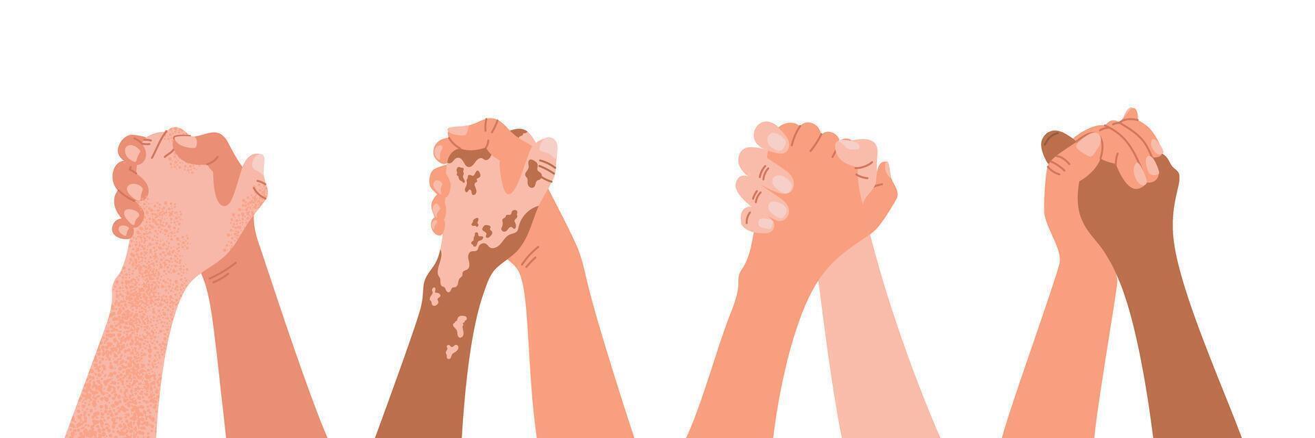 Diverse hands holding together. Team cooperation, support, trust concept. Albinism, vitiligo, pigment spots. Flat vector