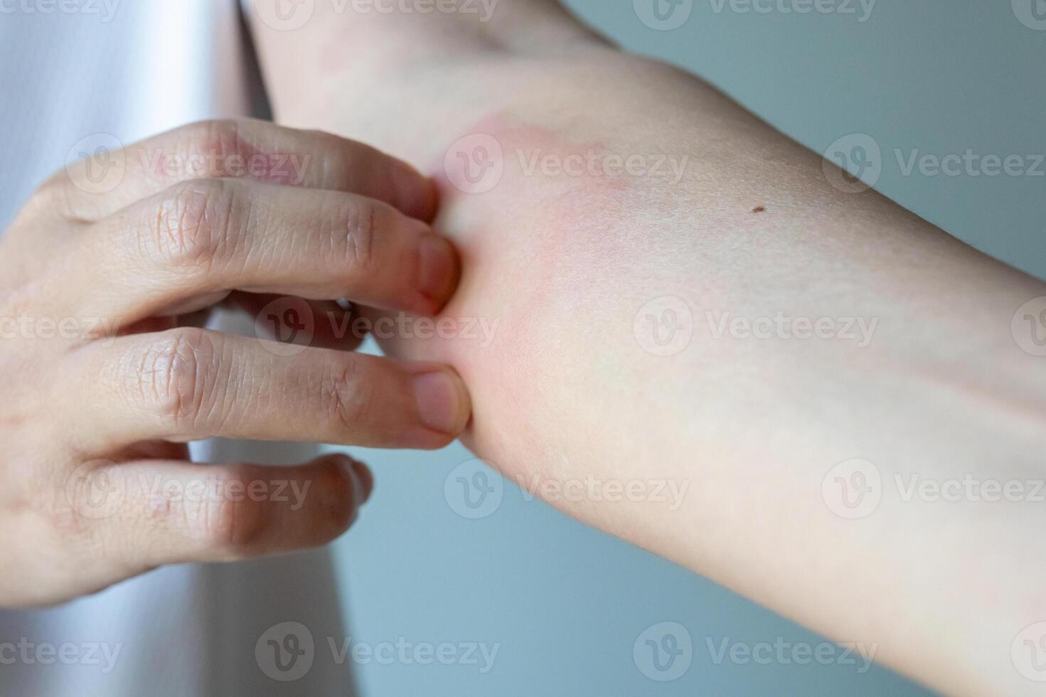 Young asian man itching and scratching on arm from allergic itchy dry skin eczema dermatitis insect bites photo