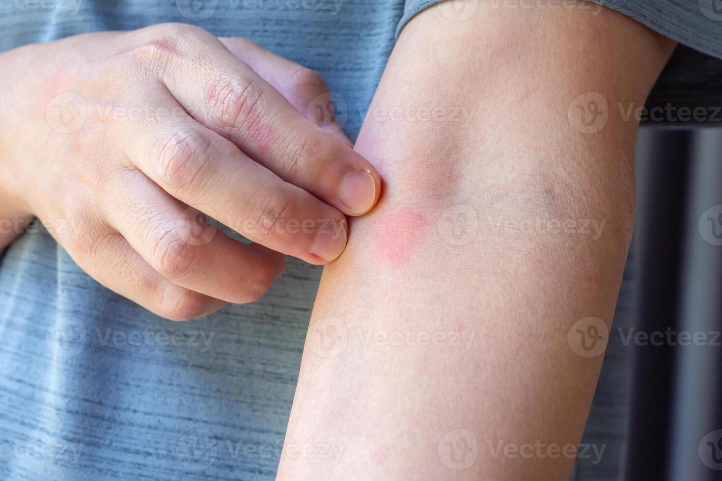 Young asian man itching and scratching on arm from allergic itchy dry skin eczema dermatitis insect bites photo