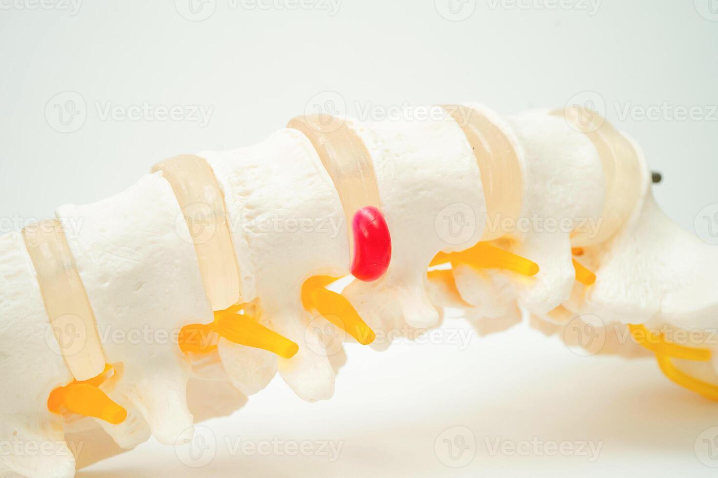 Spinal nerve and bone, Lumbar spine displaced herniated disc fragment, Model for treatment medical in the orthopedic department. photo