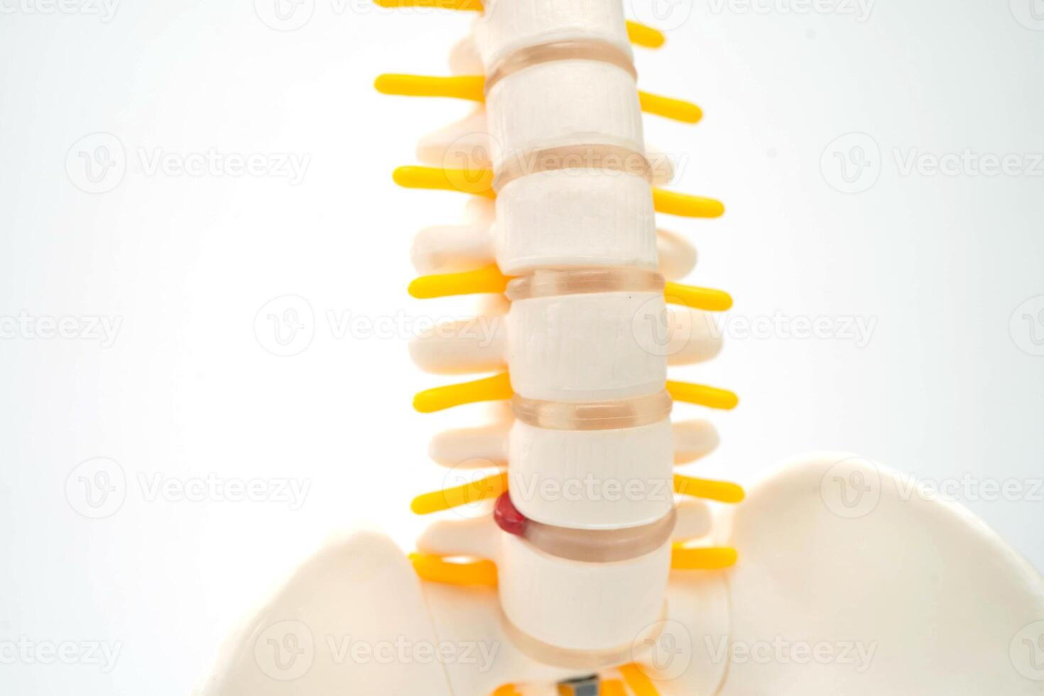 Spinal nerve and bone, Lumbar spine displaced herniated disc fragment, Model for treatment medical in the orthopedic department. photo