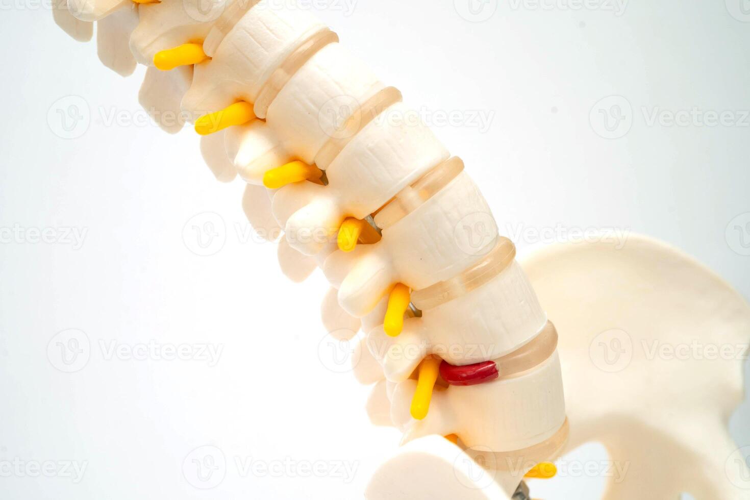 Spinal nerve and bone, Lumbar spine displaced herniated disc fragment, Model for treatment medical in the orthopedic department. photo