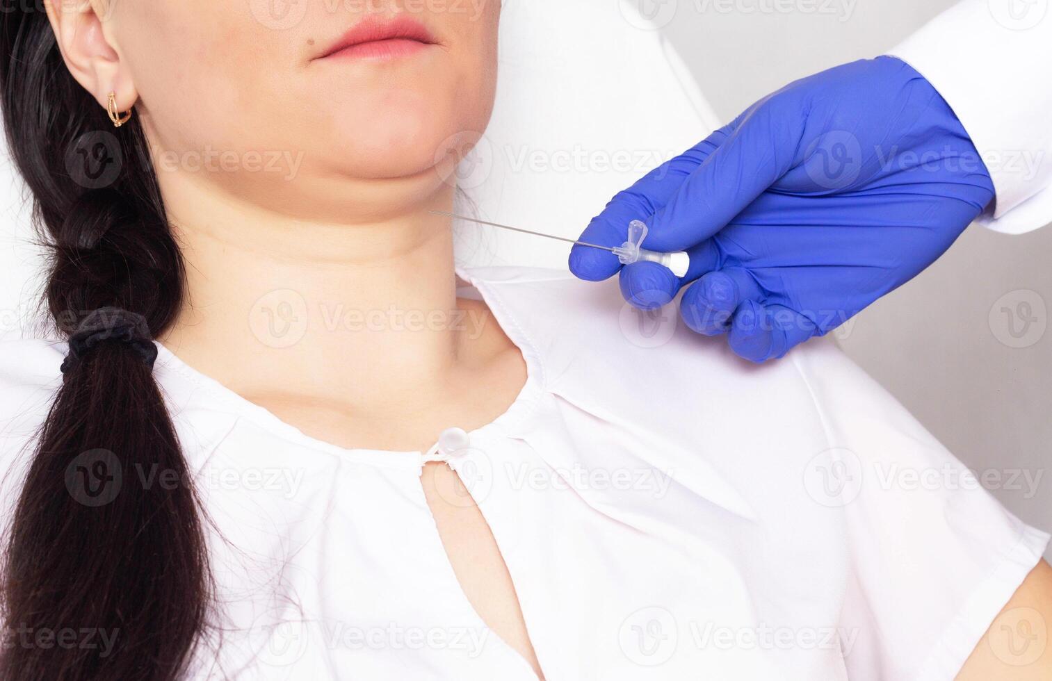 The doctor makes the patient double chin thread lifting with absorbable threads, cosmetology, thread lifting photo