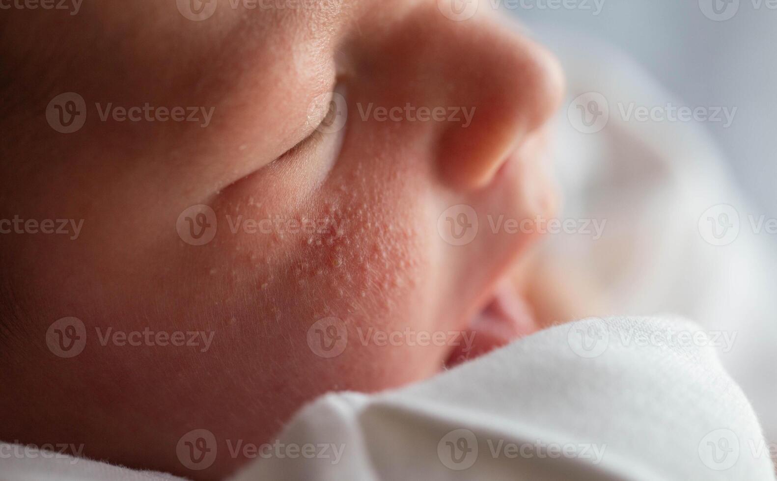 Pimples on the face of a newborn. Baby's adaptation to the environment, close-up photo