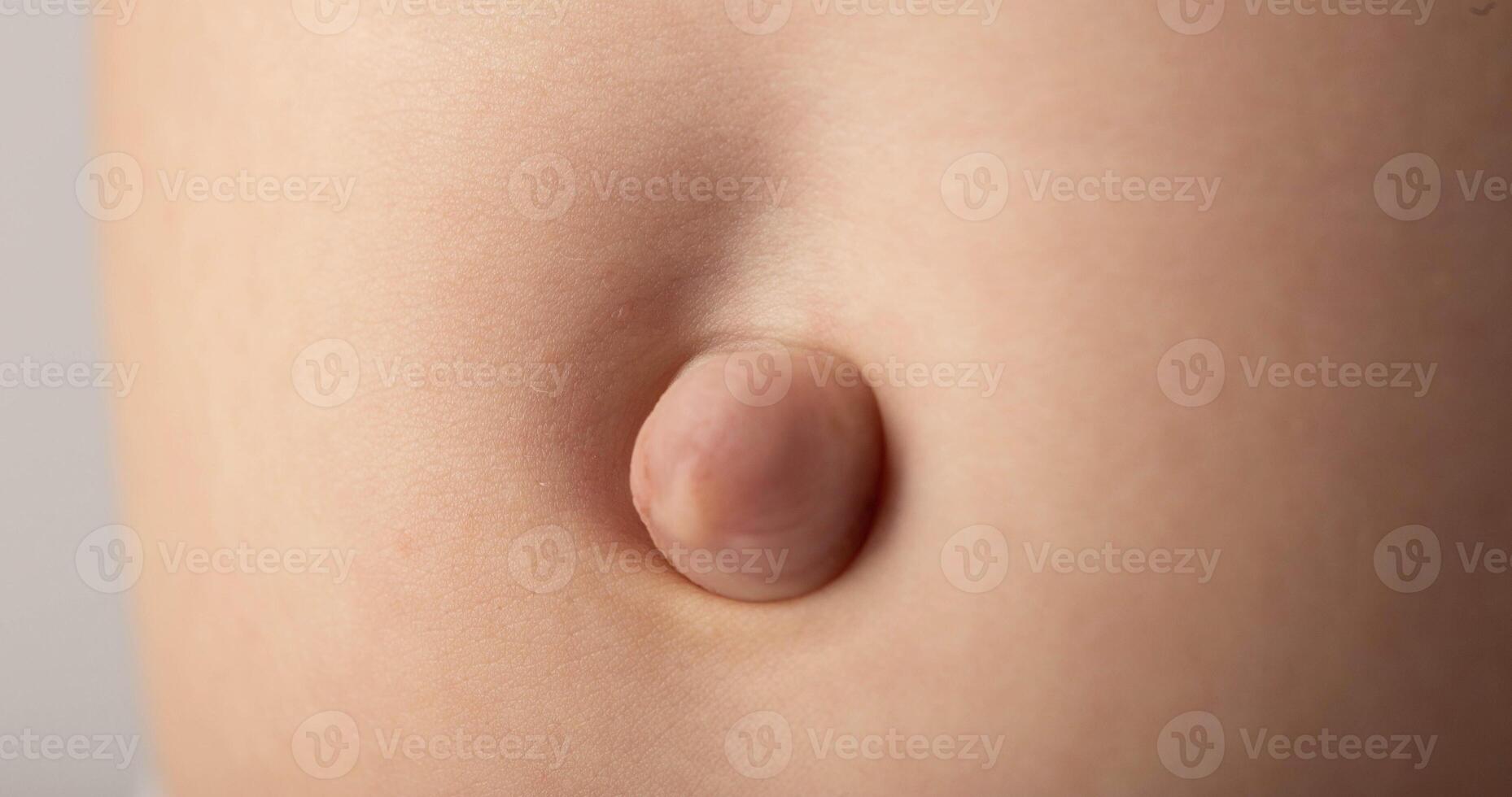 Umbilical hernia in newborns on the stomach, close-up. Treatment of hernias in children without surgery. Convex navel. Children's health. Macro photo