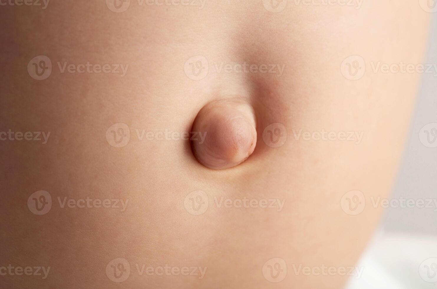Umbilical hernia in newborns on the stomach, close-up. Treatment of hernias in children without surgery. Convex navel. Children's health. photo