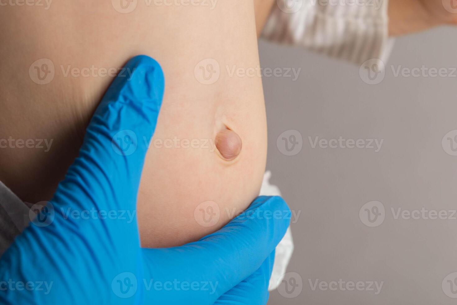 Doctor's hands in blue medical gloves examine an umbilical hernia in a child, close-up. Treatment of umbilical hernias without surgery. photo