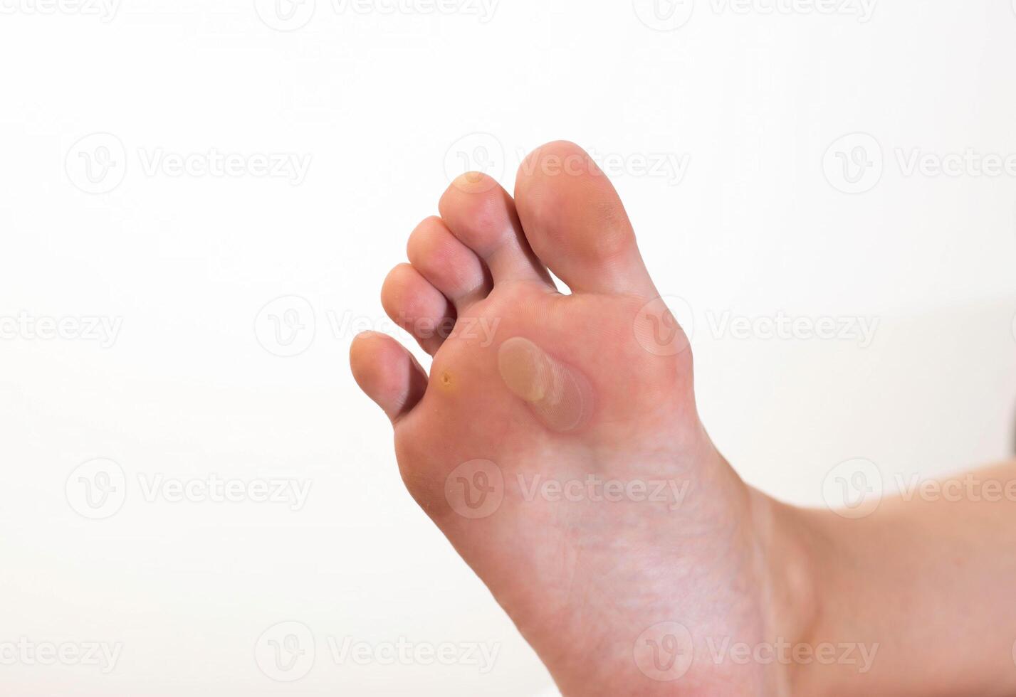 A person's foot has a large callus on its foot due to rubbing from uncomfortable shoes. Rod wart on the sole of the foot, close-up. Copy space for text photo