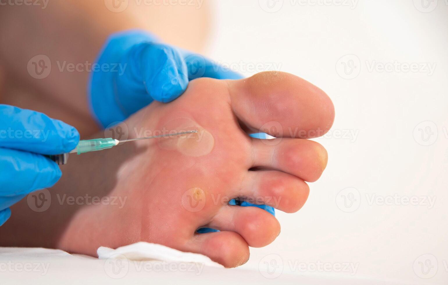 surgery to pierce and remove fluid from a callus on the foot, close-up photo