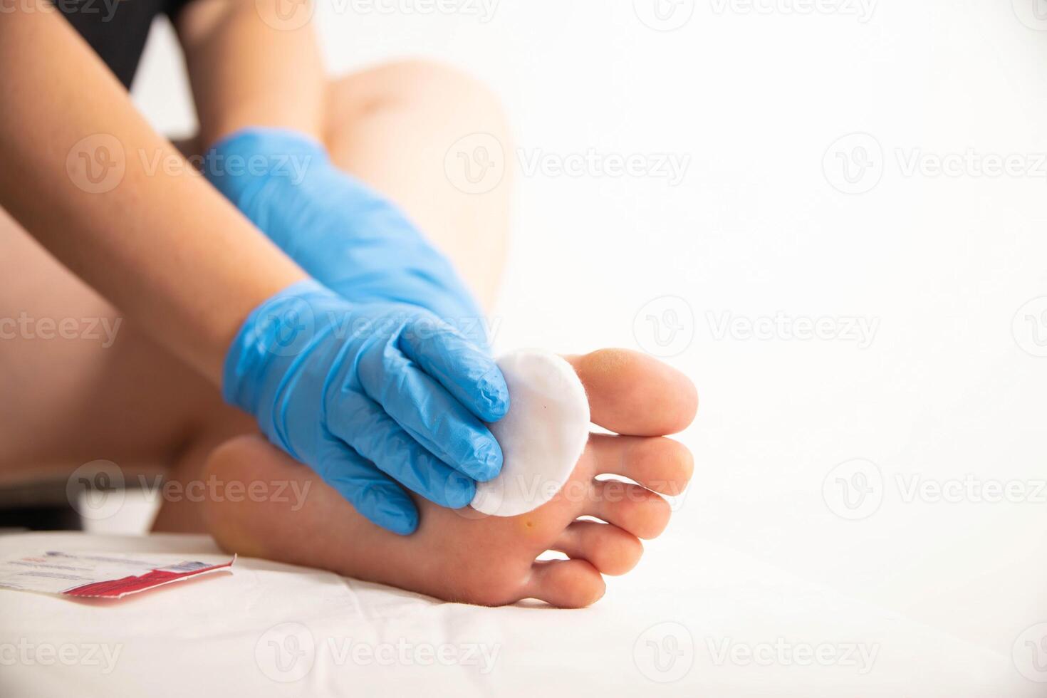 Treatment of a callus on the foot with a special solution after surgery to remove the callus and wart. Copy space for text photo