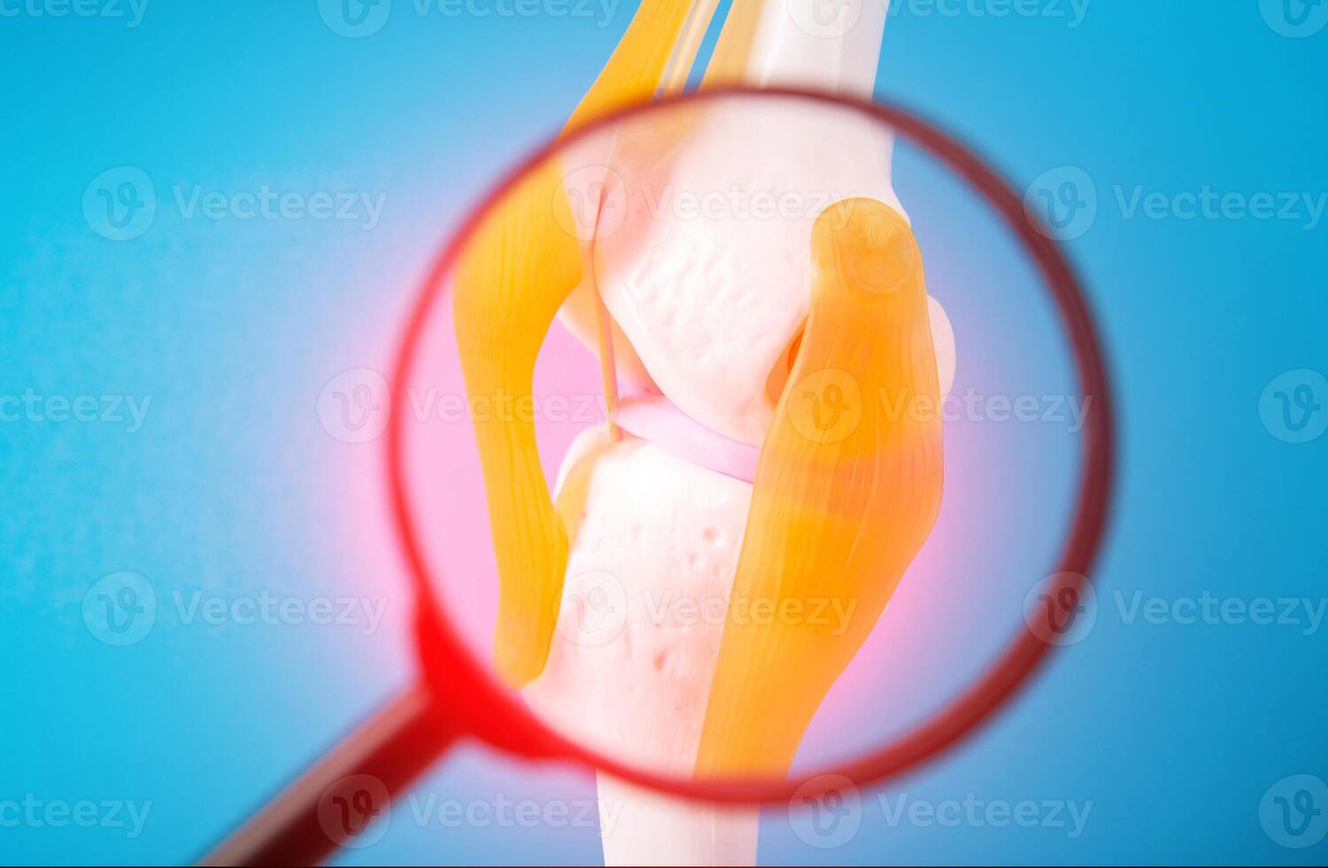 Medical mockup of a knee joint on a blue background under a magnifying glass. Concept of pain and inflammation in the knee joint, redness. Gonarthrosis and arthritis. Knee cartilage injury photo