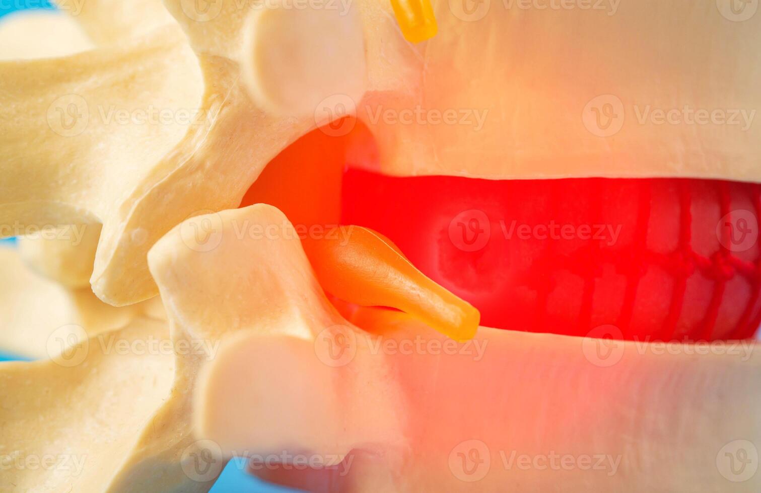 Red inflamed spine with a compressed nerve root, close-up. Neuralgia and radiculitis in diseases of the spine. Back pain, close-up photo