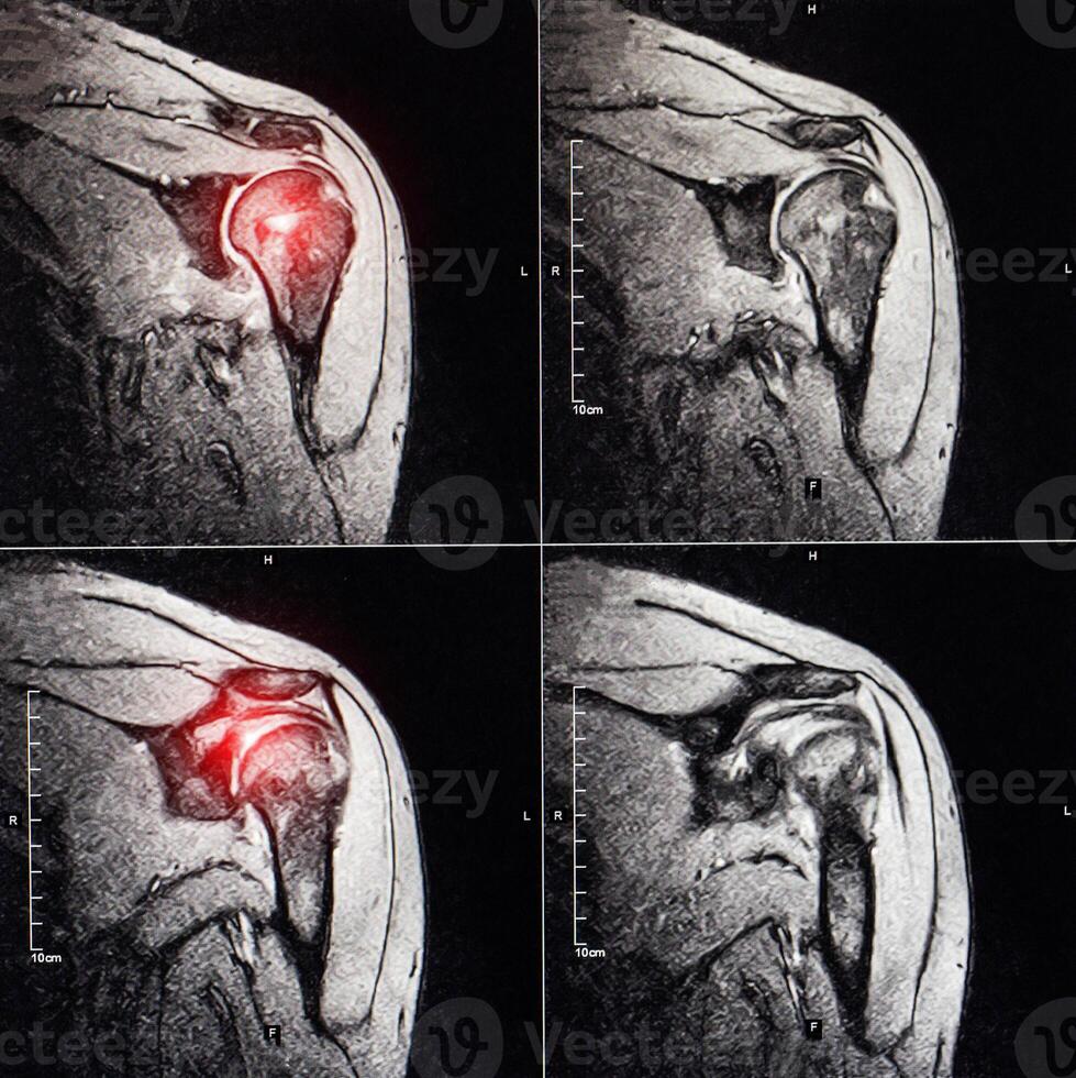 MRI image of the shoulder joint after a fracture and dislocation. Impression fracture of the humeral head. Shoulder injury, sprain, synovitis. The redness and inflammation are red on the MRI image. photo