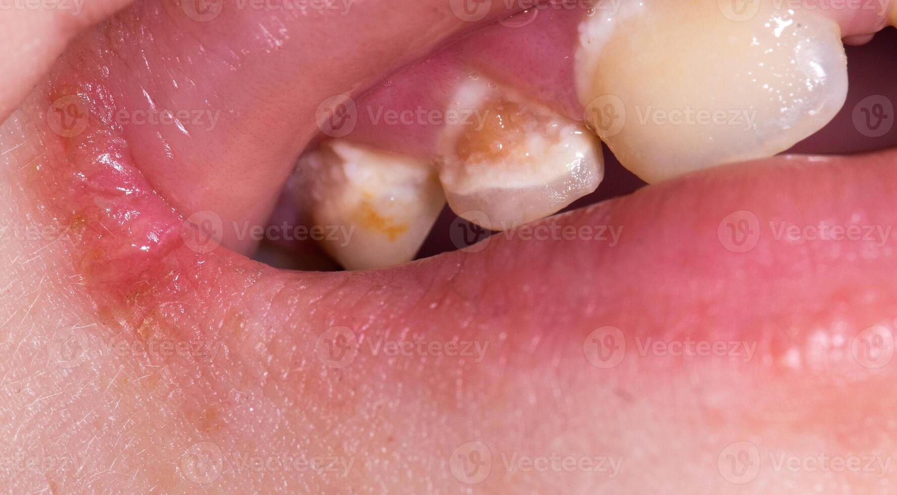 Insufficient hygiene of children's primary teeth. Destruction of enamel and development of caries, close-up photo