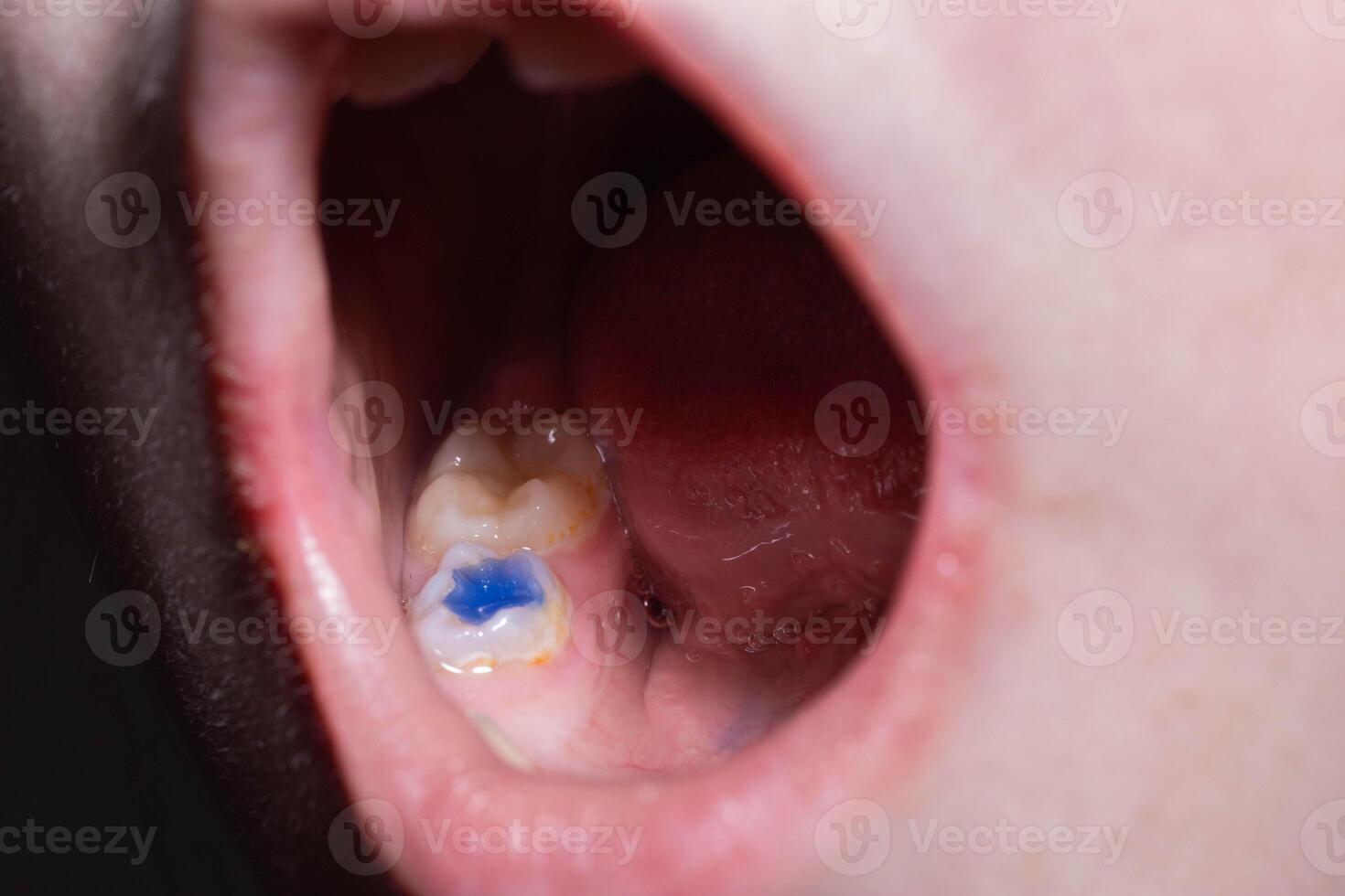 Blue filling in a tooth in a child's mouth. The concept of modern fillings in dentistry for caries in children, macro photo