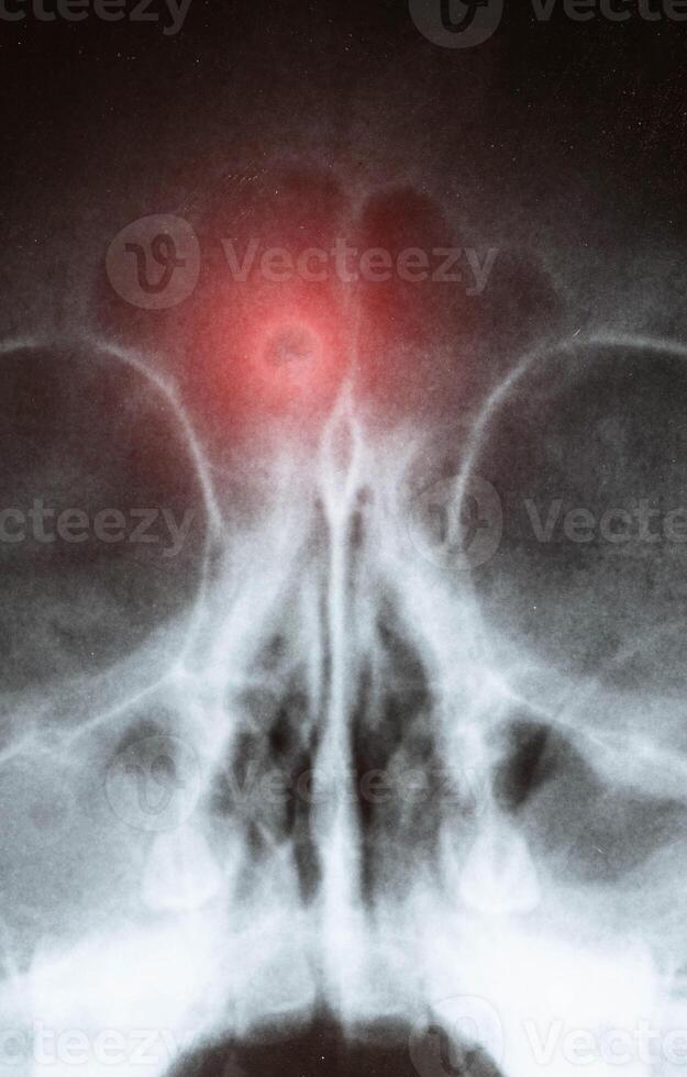 X-ray of sinusitis in a child. Inflammation of the nasal sinuses with purulent sinusitis, close-up photo