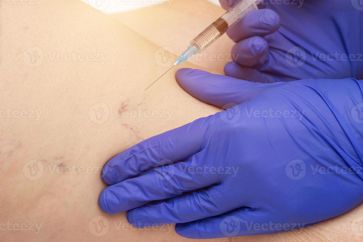 The doctor makes an injection of sclerotherapy in varicose veins, phlebology, close-up, professional photo